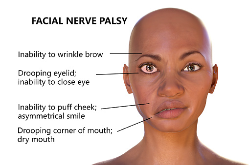 Pediatric Facial Nerve Palsy
