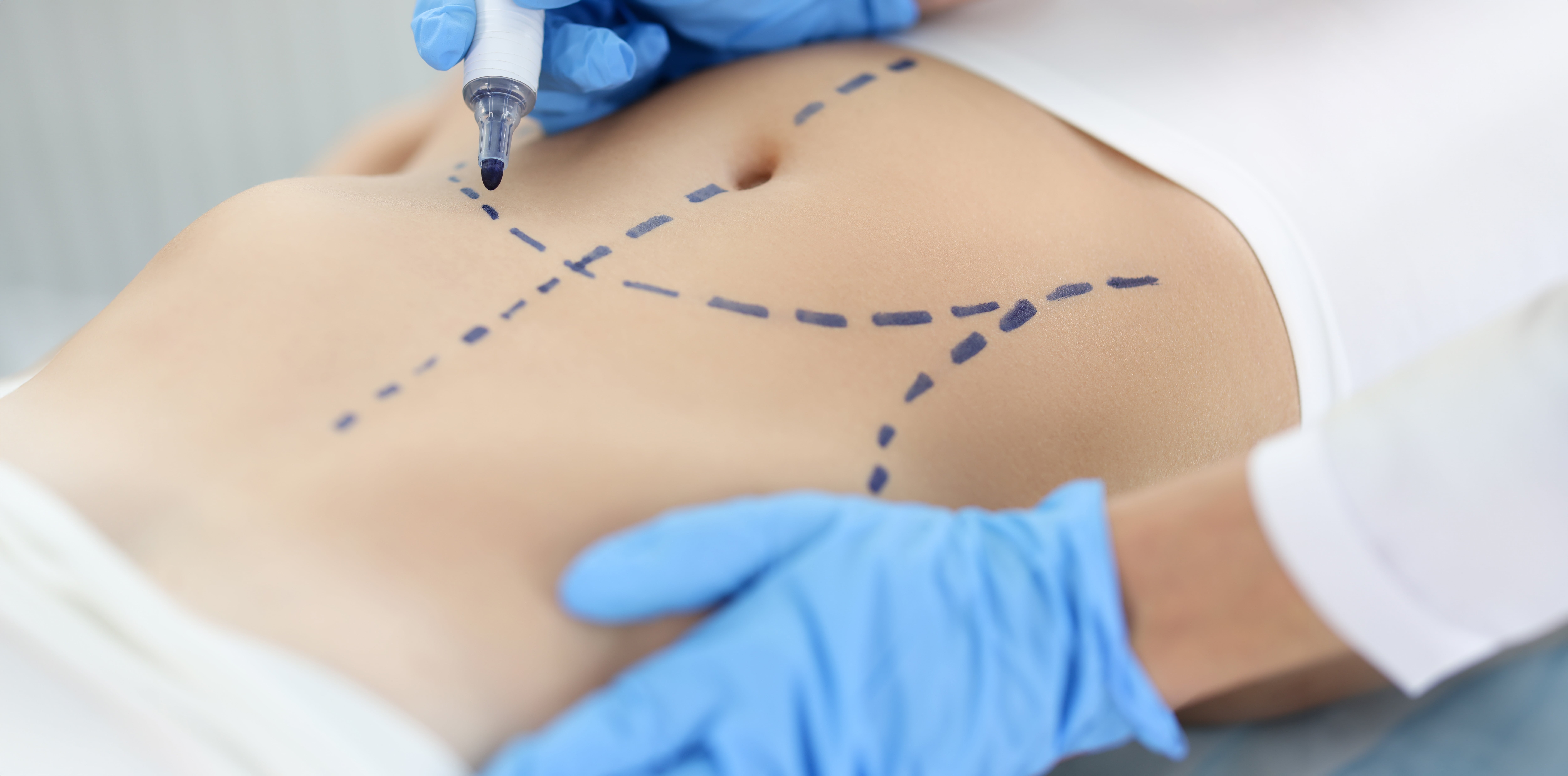 Casos de negligencia médica más comunes en cirugías estéticas