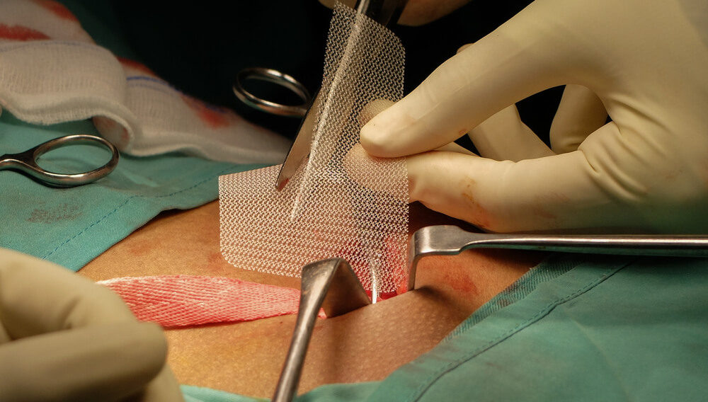 Surgeon implanting hernia mesh during surgery — image related to defective hernia mesh complications and legal claims in Chicago.
