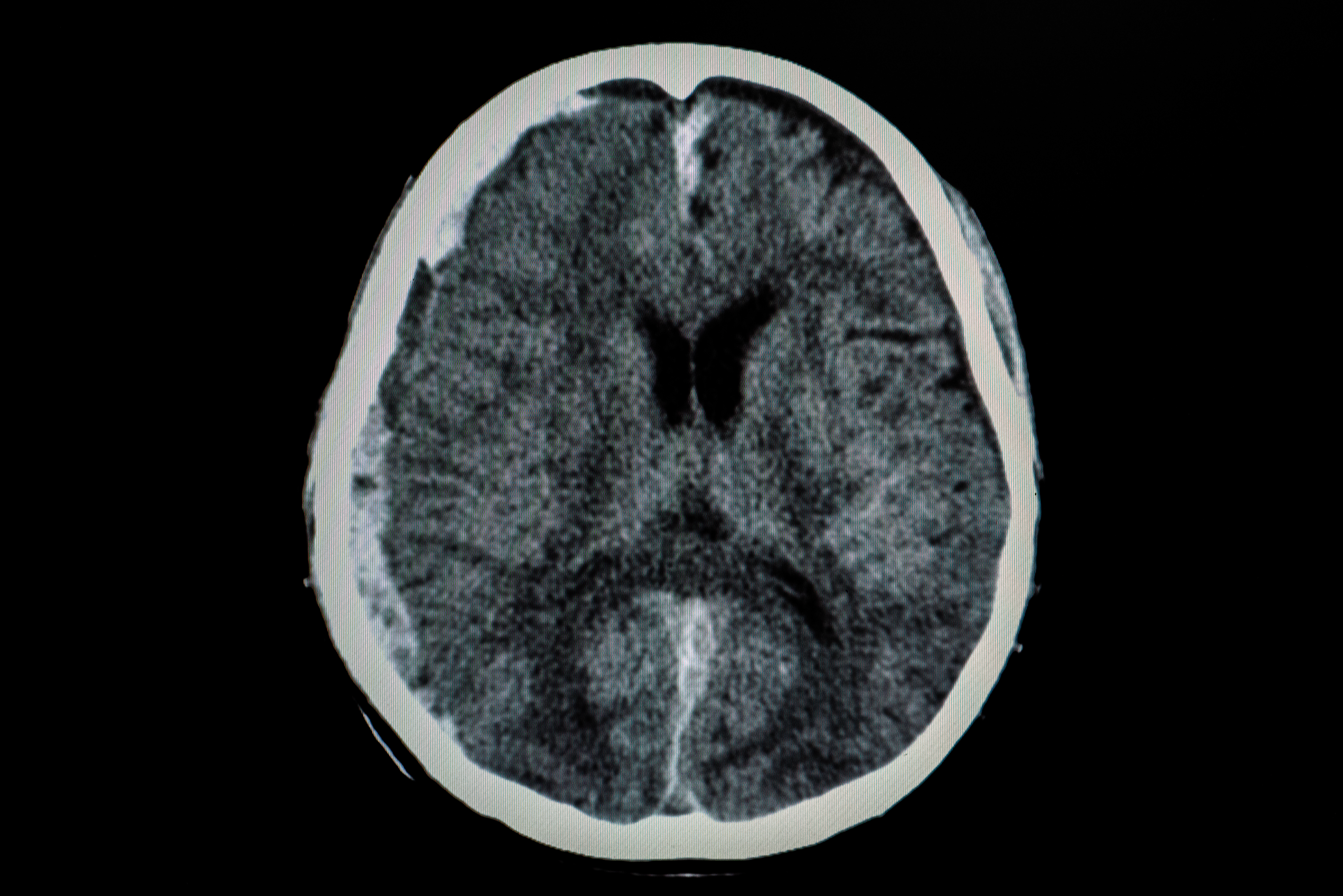 abogado de lesiones cerebrales traumaticas en Chicago, IL